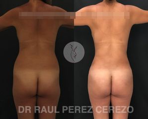 Antes y después de Lipoescultura