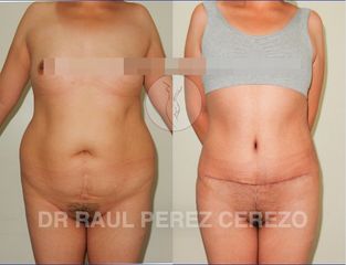 Antes y después de Abdominoplastia