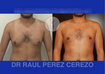 Antes y después de Ginecomastia