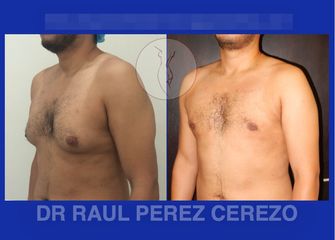 Antes y después de Ginecomastia