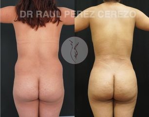 Antes y después de Gluteoplastia