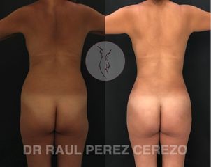 Antes y después de Liposucción