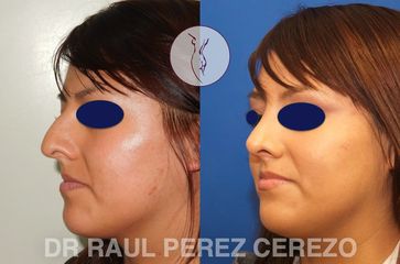 Antes y después de  Rinoplastia