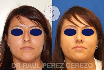 Antes y después de Rinoplastia