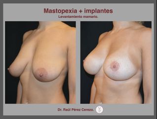 Antes y después de Mastopexia con implantes