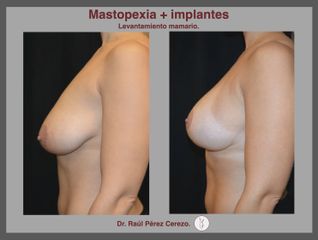 Antes y después de Mastopexia + implantes