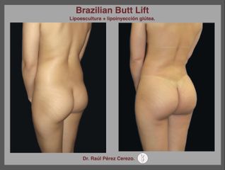 Antes y después de Lipoescultura con lipoinyección