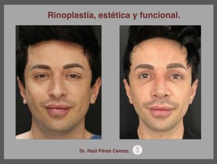 Antes y después de Rinoplastia 