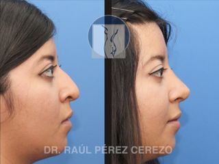 Antes y después de Rinoplastia