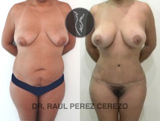 Antes y después de Abdominoplastia 