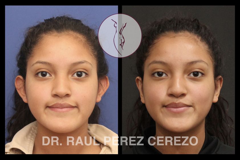 Otoplastia antes y después - 737215