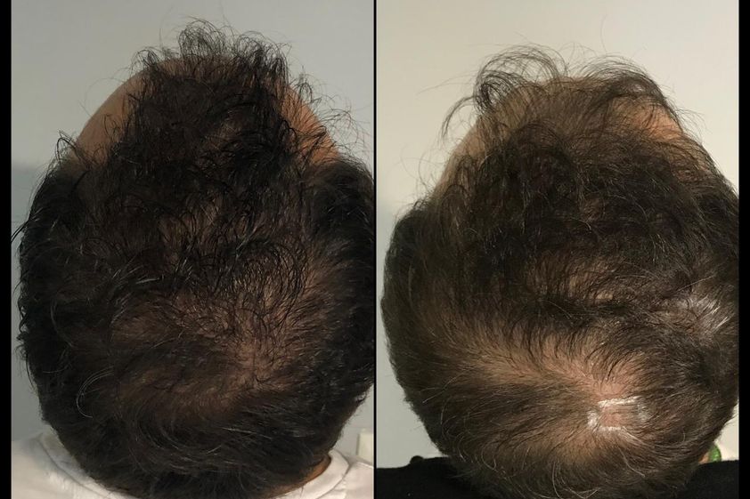 Micropigmentación antes y después - 787472
