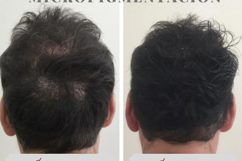 Micropigmentación antes y después - 787601