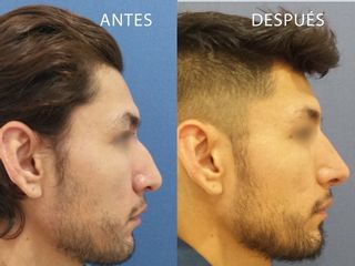 Antes y después de Rinoplastia
