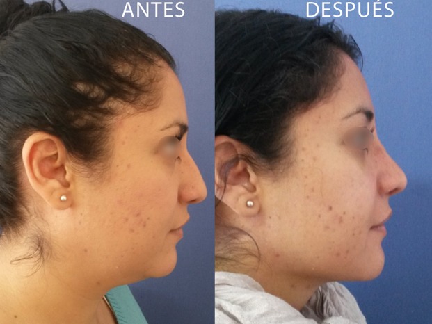 fosas nasales desiguales despues de rinoplastia fosas nasales desiguales despues de rinoplastia