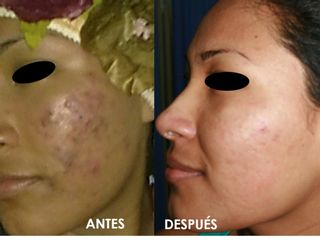 Antes y después Tratamiento Acné-Peeling