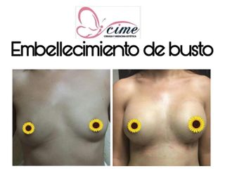 Aumento de Busto - CIME Centro Integral de Cirugía y Medicina Estética