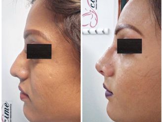 Rinoplastia antes y después - 836175