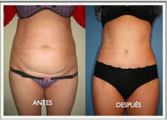 Antes y después Abdominoplastia