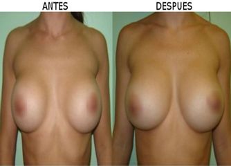 Antes y después Aumento busto