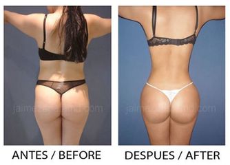 Antes y después Lipoescultura