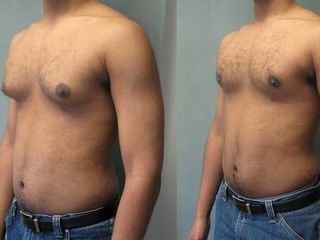Antes y después Ginecomastia