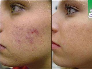 Antes y después de tratamiento de eliminación de acné