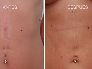 Antes y despues de tratamiento de queloides