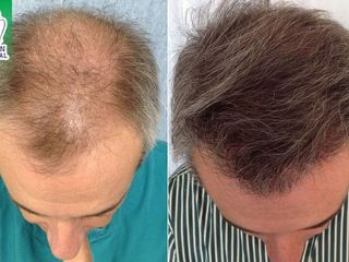 Antes y después de trasplante de cabello