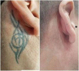 Antes y después eliminación de tatuaje