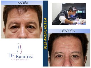 Blefaroplastia- Dr. Edgar Ramírez López