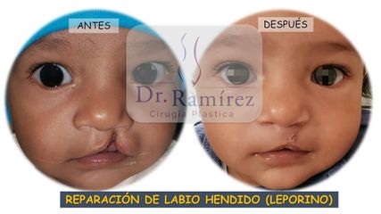 Labio hendido (Leporino)  - Dr. Edgar Ramírez López