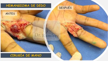 Hemangioma del dedo - Dr. Edgar Ramírez López