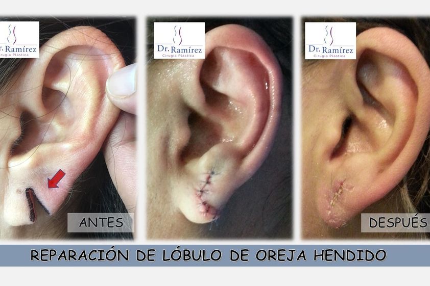 Cirugía plástica reconstructiva antes y después - 660851