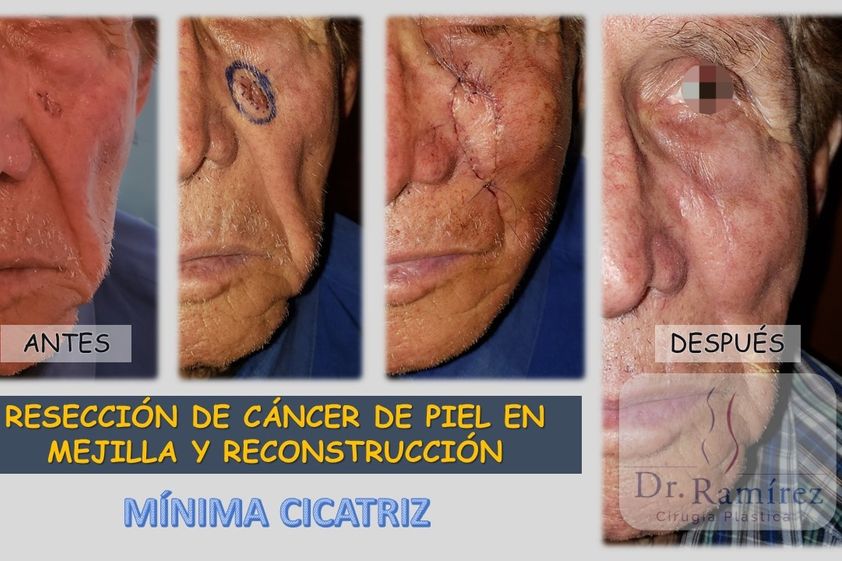 Carcinoma Basocelular antes y después - 660852
