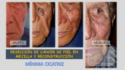 Cancer mejilla  - Dr. Edgar Ramírez López