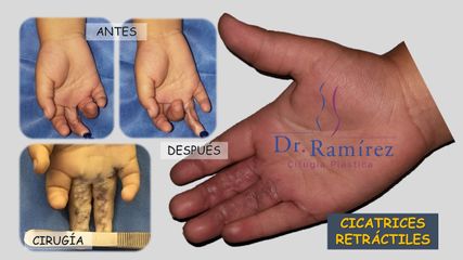 Cicatriz retráctil mano - Dr. Edgar Ramírez López