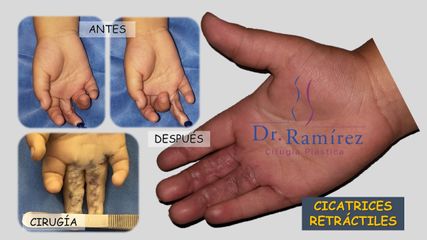 Cicatriz retráctil mano