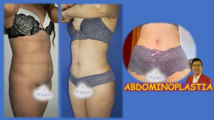 Abdominoplastia cicatriz oculta -  Dr. Edgar Ramírez López