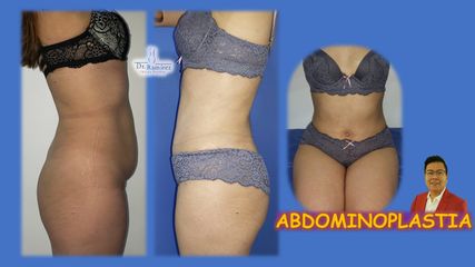 Abdominoplastia sin gorditos - Dr. Edgar Ramírez López