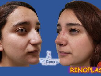 Rinoplastia - 661841