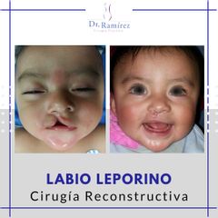 Labio Leporino - Dr. Edgar Ramírez López