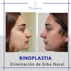 Rinoplastia - Dr. Edgar Ramírez López
