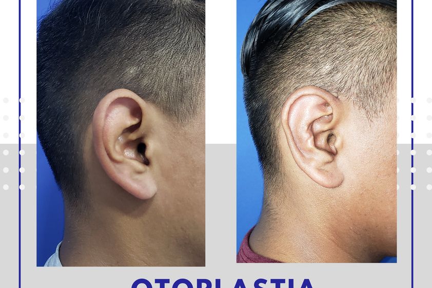 Otoplastia antes y después - 663326