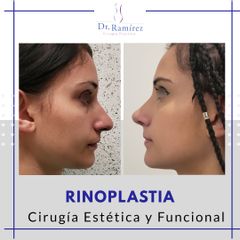 Rinoplastia - Dr. Edgar Ramírez López