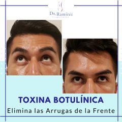 Toxina Frente Hombre - Dr. Edgar Ramírez López