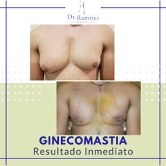 Ginecomastia - Dr. Edgar Ramírez López