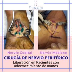 Cirugía de Nervio periférico - Dr. Edgar Ramírez López