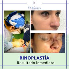 Rinoplastia - Dr. Edgar Ramírez López