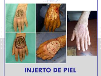 Carcinoma Basocelular antes y después - 688098
